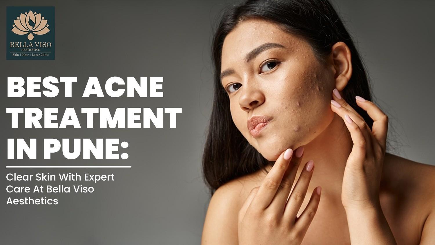 Best Acne Treatment in Pune
