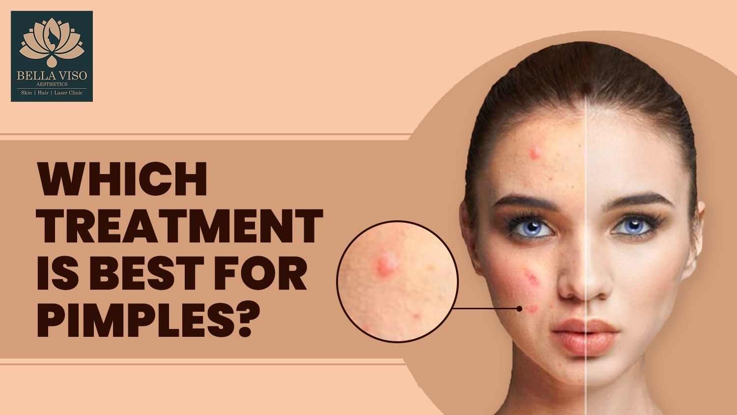 Which Treatment is Best for Pimples?